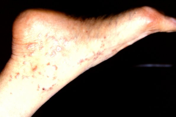 Lichen Planus (15)