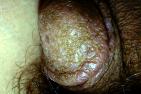Lichen Planus (21)