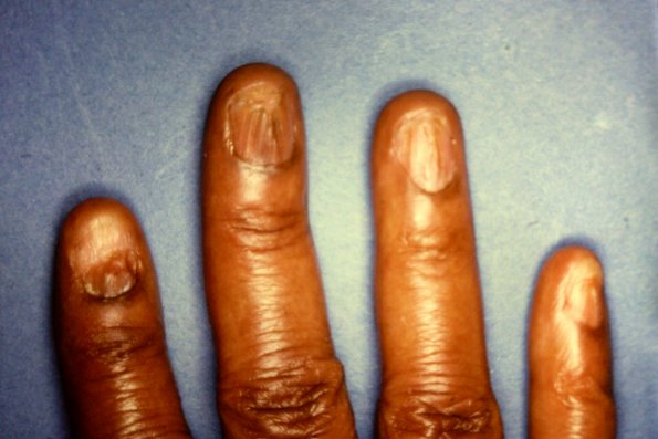 Lichen Planus (22)