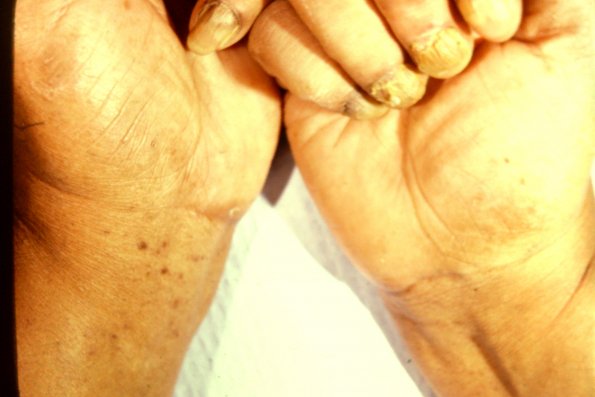 Lichen Planus (23)