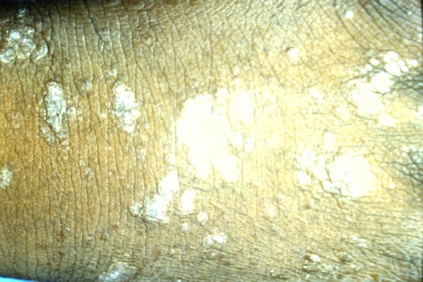 Lichen Planus (25)