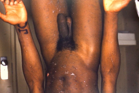 Lichen Planus (28)
