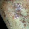 Lichen Planus (4)