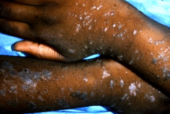Lichen Planus (47)