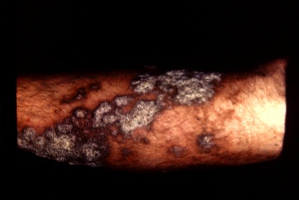 Lichen Planus (48)