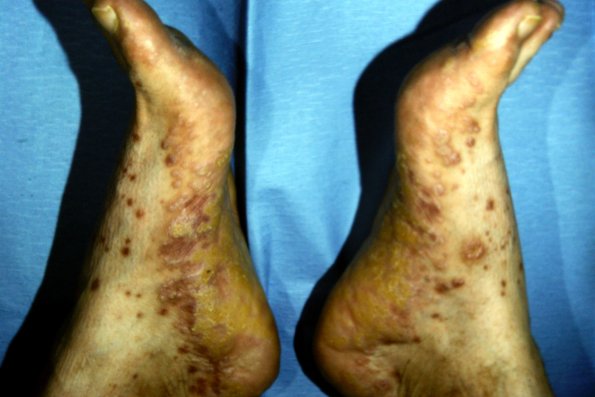 Lichen Planus (7)