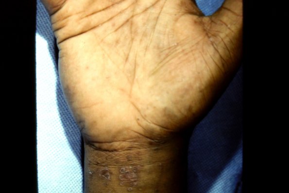 Lichen Planus Palmar (2)