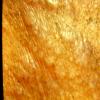 Lichen Simplex Chronicus (12)