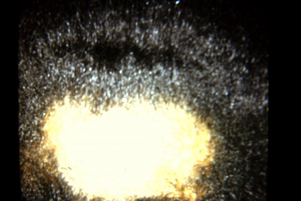 Lichen Simplex Chronicus (15)