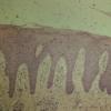 Lichen Simplex Chronicus (20)