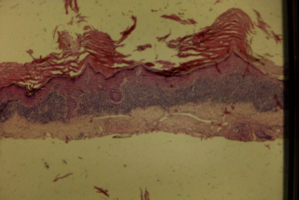 Lichenoid Actinic Keratosis