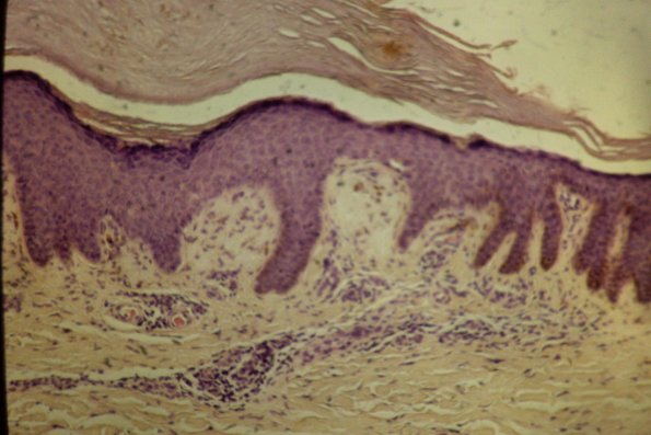 Lichenoid Amyloid