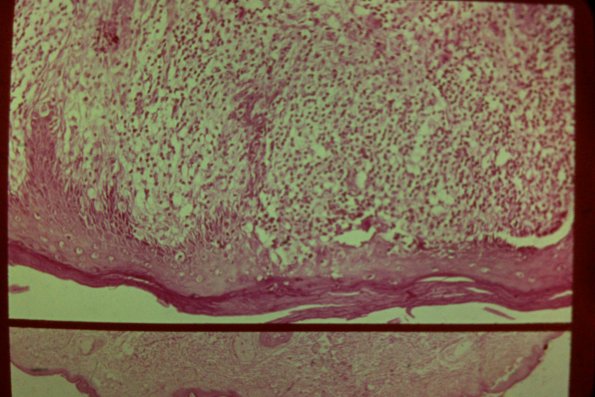 Lichenoid Drug Erruption