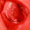 Oral Lichen Planus