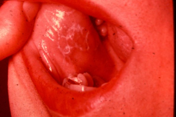 Oral Lichen Planus