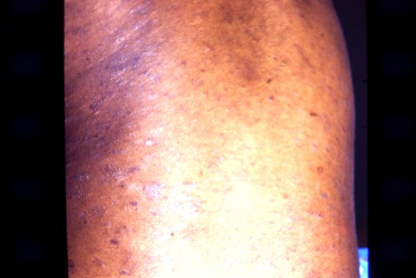 Pityriasis Lichenoides Chronicus (3)