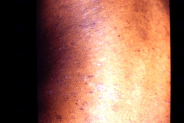 Pityriasis Lichenoides Chronicus