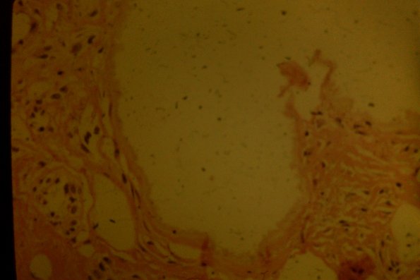 Lipomembranous Panniculitis (6)