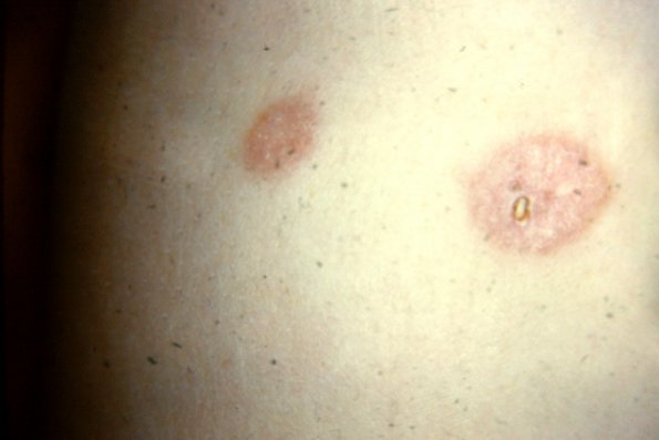 Necrobiosis Lipoidica (11)