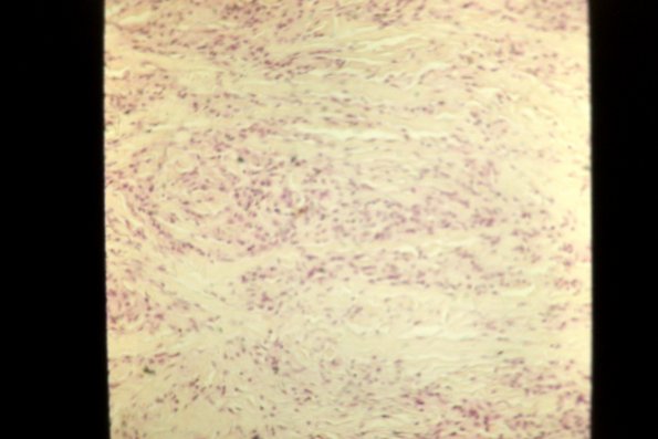 Necrobiosis Lipoidica (18)