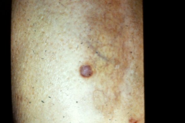 Necrobiosis Lipoidica (5)