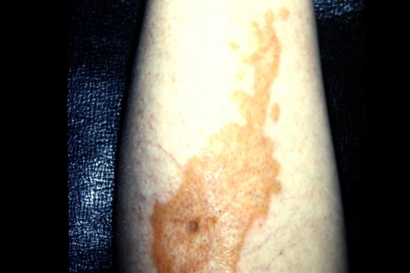 Necrobiosis Lipoldica