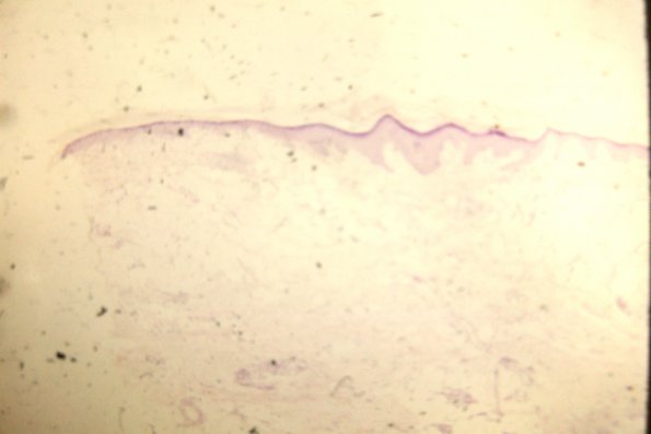 Nevus Lipomatosus Superficialis (2)