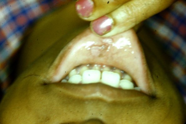 Verruce Of Lip Condyloma accumulatum