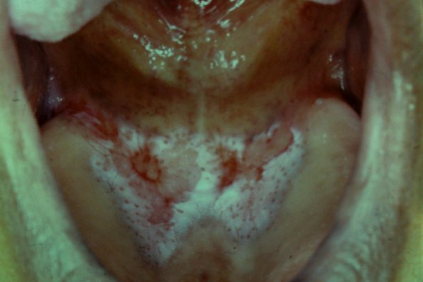 Discoid Lupis Erythim Palate