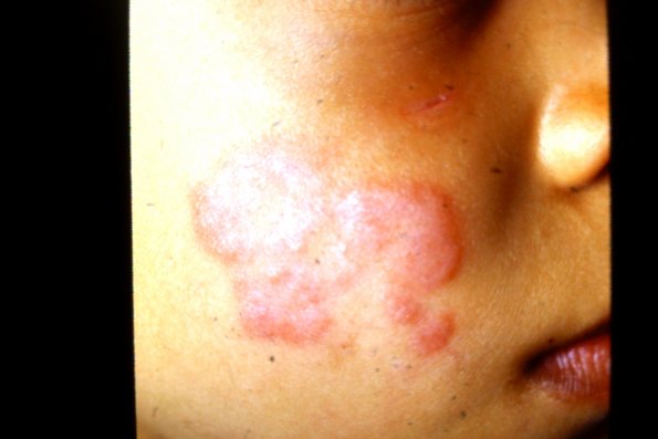 Disgoid Lupus