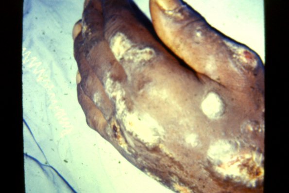 Hypertrophic DLE Lupus Ulcerating LE