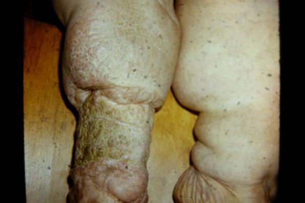 Lymphedema (2)