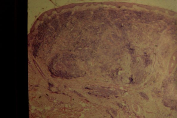 Lymphocytoma (2)