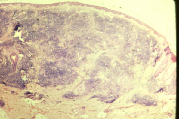 Lymphocytoma (5)