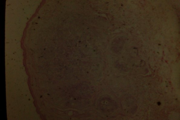 Cutaneous Lymphodonoma (18)