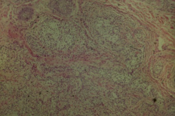 Cutaneous Lymphodonoma (3)