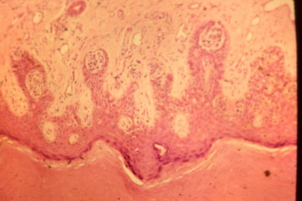 Cutaneous Lymphodonoma (33)