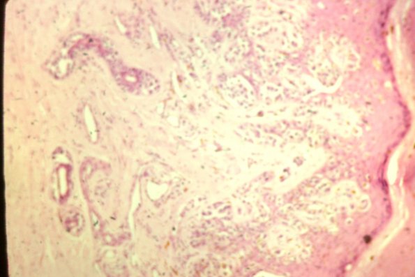 Cutaneous Lymphodonoma (35)