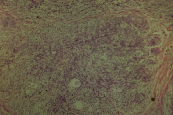 Cutaneous Lymphodonoma (4)