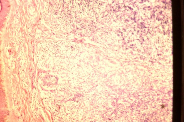 Cutaneous Lymphodonoma (46)