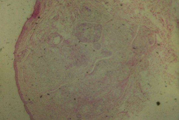 Cutaneous Lymphodonoma (5)