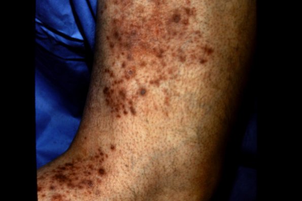 Lymphomatoid Papulosis (13)