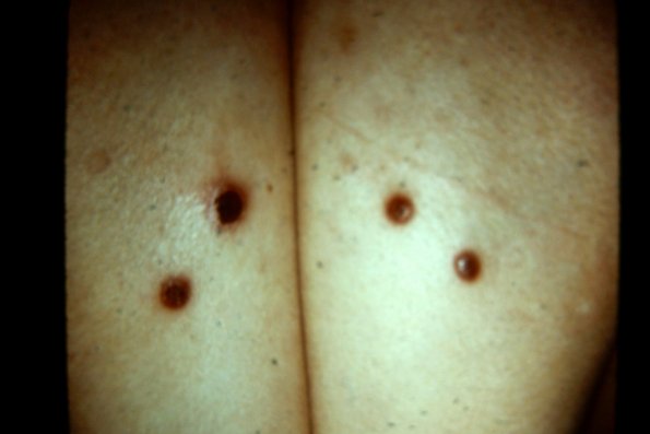 Lymphomatoid Papulosis (17)