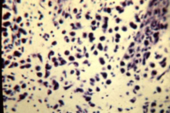 Lymphomatoid Papulosis (18)