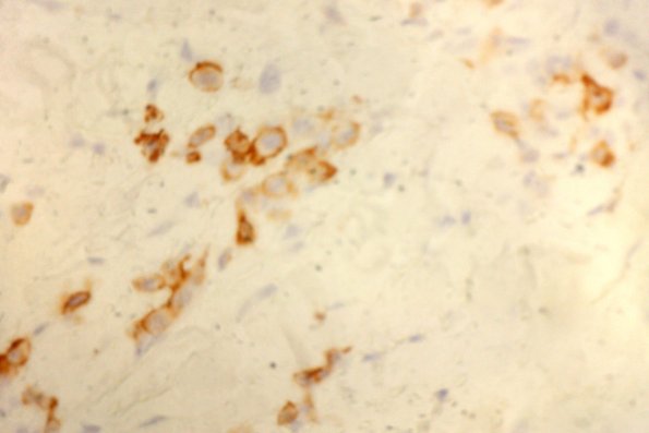Lymphomatoid Papulosis (20)