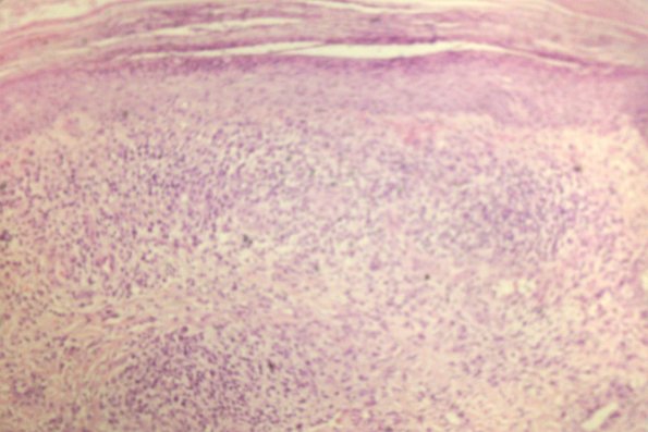 Lymphomatoid Papulosis (24)