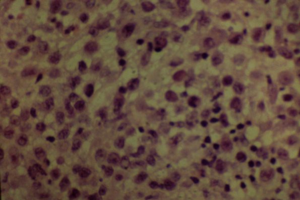 Lymphomatoid Papulosis (27)