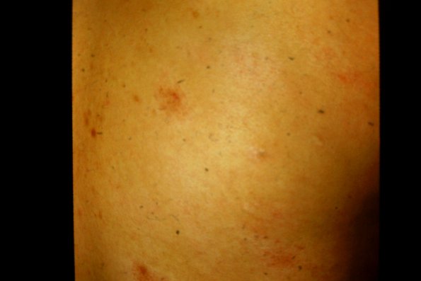 Lymphomatoid Papulosis (5)