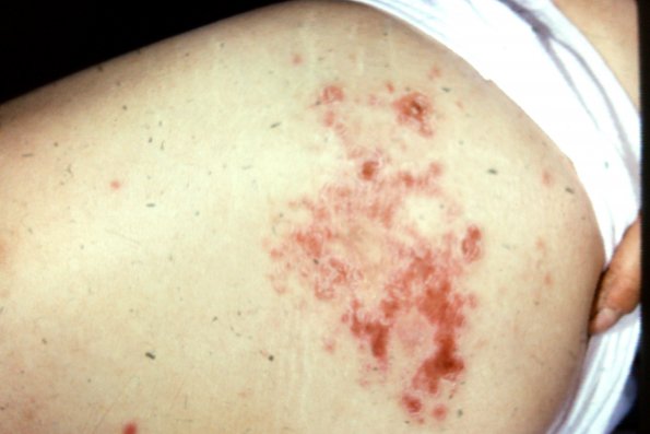 Lymphomatoid Papulosis (8)