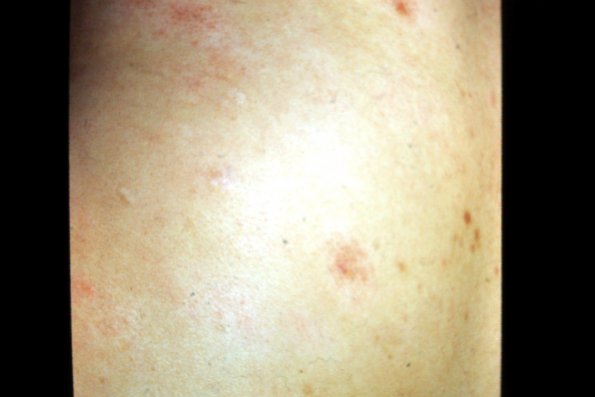 Lymphomatoid Papulosis